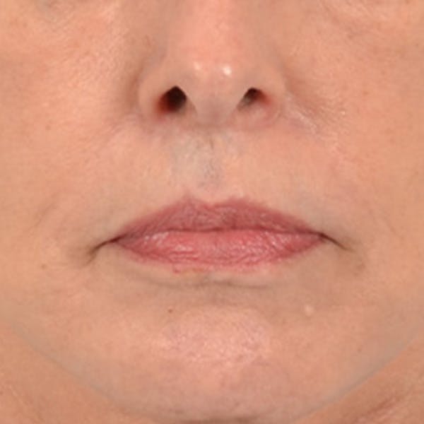 Lip Lift Before & After Gallery - Patient 236622 - Image 2