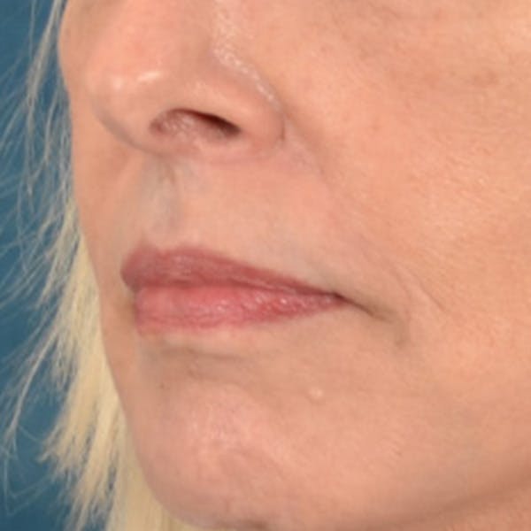 Lip Lift Before & After Gallery - Patient 236622 - Image 4