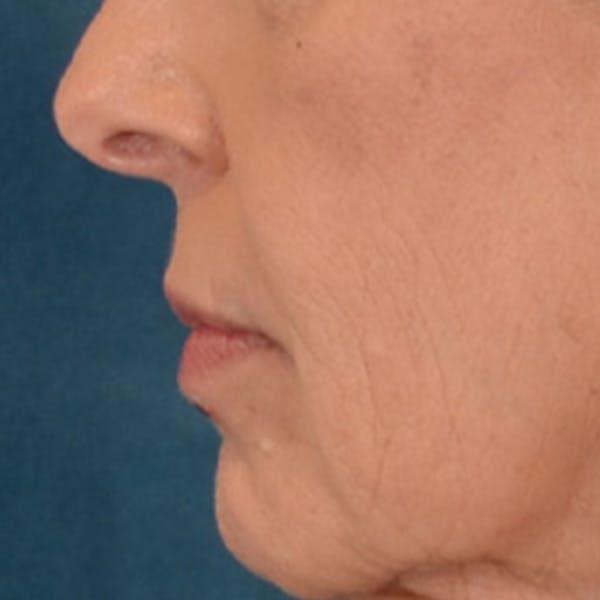 Lip Lift Before & After Gallery - Patient 236622 - Image 5