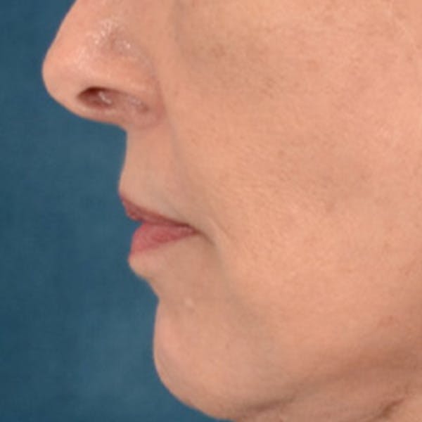 Lip Lift Before & After Gallery - Patient 236622 - Image 6