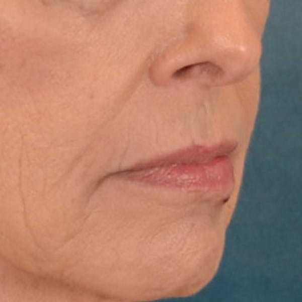 Lip Lift Before & After Gallery - Patient 236622 - Image 7