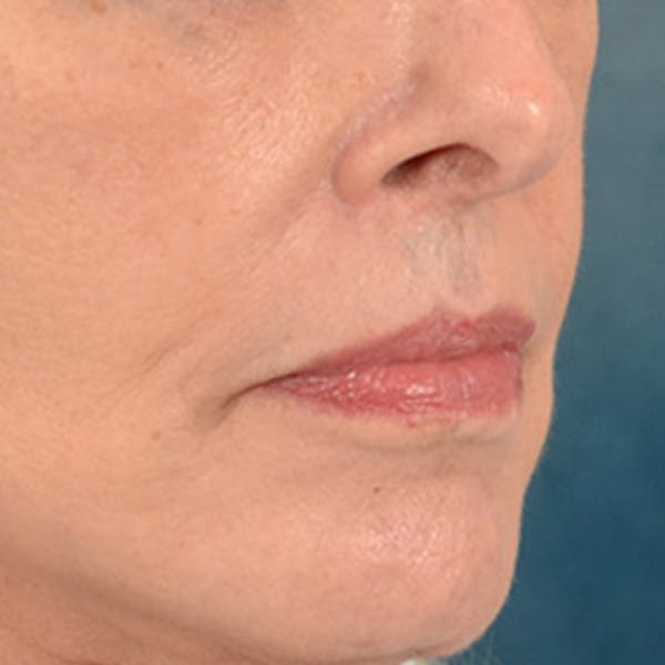 Lip Lift Before & After Gallery - Patient 236622 - Image 8