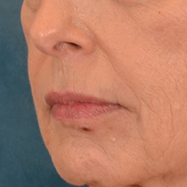 Lip Lift Before & After Gallery - Patient 236622 - Image 3