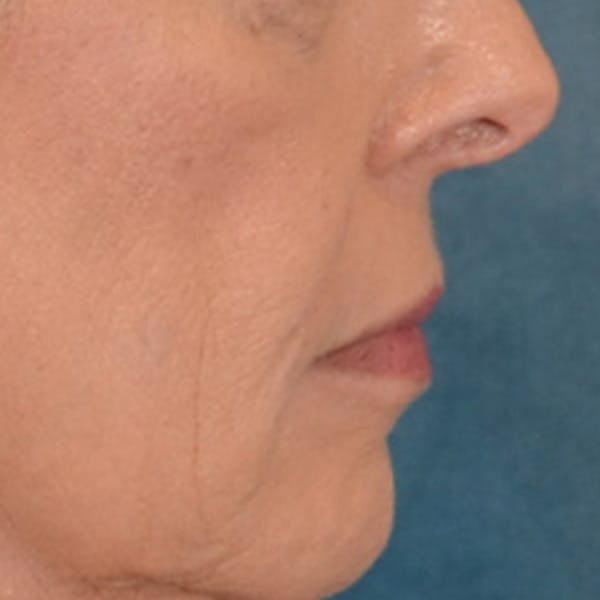 Lip Lift Before & After Gallery - Patient 236622 - Image 9