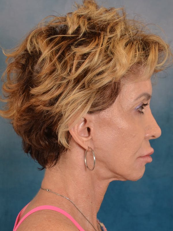Deep Plane Facelift Before & After Gallery - Patient 148969 - Image 5