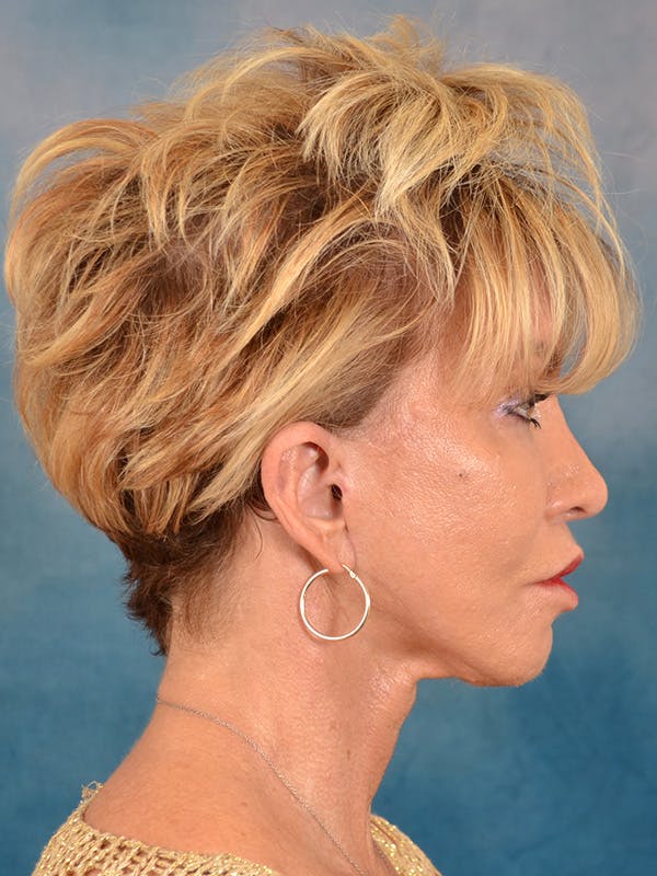 Deep Plane Facelift Before & After Gallery - Patient 148969 - Image 6