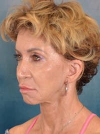 Deep Plane Facelift Before & After Gallery - Patient 148969 - Image 1