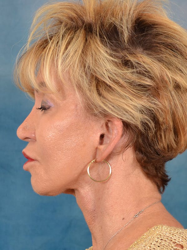Deep Plane Facelift Before & After Gallery - Patient 148969 - Image 10
