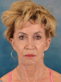 Fat Transfer Before & After Gallery - Patient 216198 - Image 1