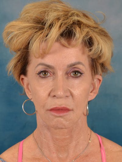 Deep Neck Lift Before & After Gallery - Patient 113385 - Image 1