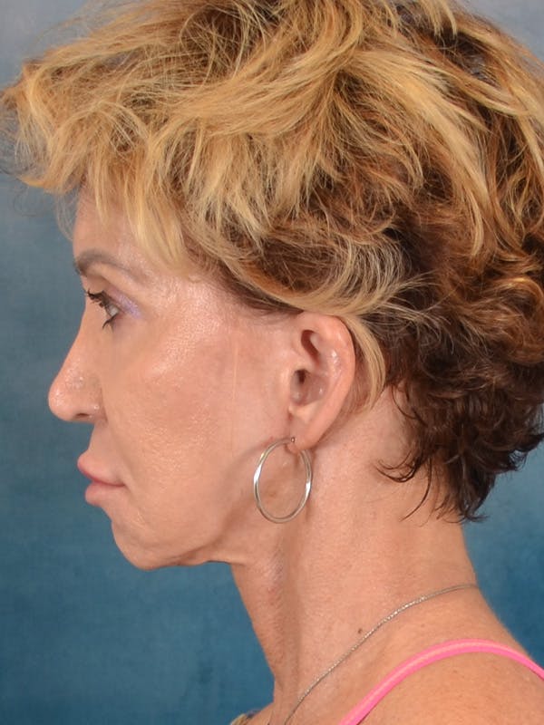 Deep Plane Facelift Before & After Gallery - Patient 148969 - Image 9