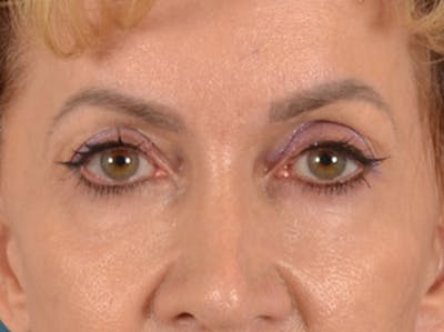 Eyelid Lift Before & After Gallery - Patient 138692 - Image 1