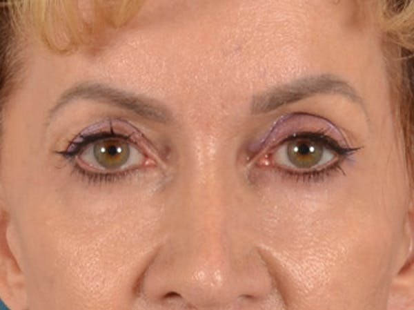 Eyelid Lift Before & After Gallery - Patient 138692 - Image 1