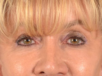 Eyelid Lift Before & After Gallery - Patient 138692 - Image 2