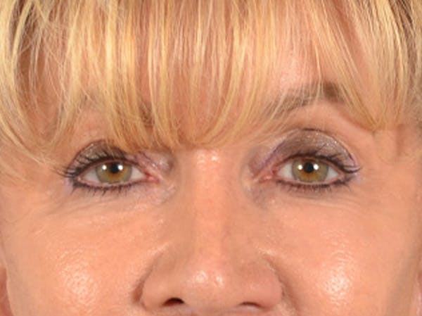 Eyelid Lift Before & After Gallery - Patient 138692 - Image 2