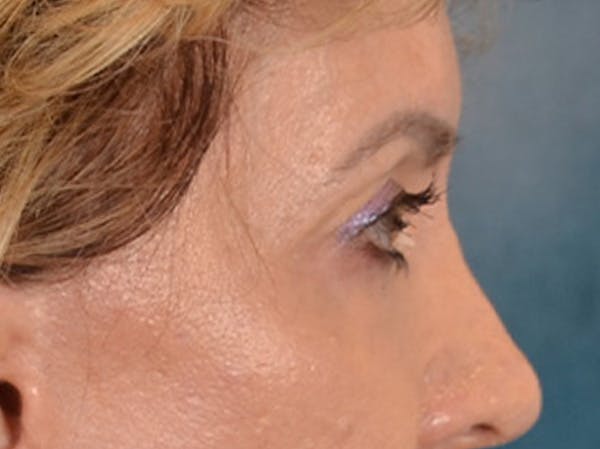 Eyelid Lift Before & After Gallery - Patient 138692 - Image 5