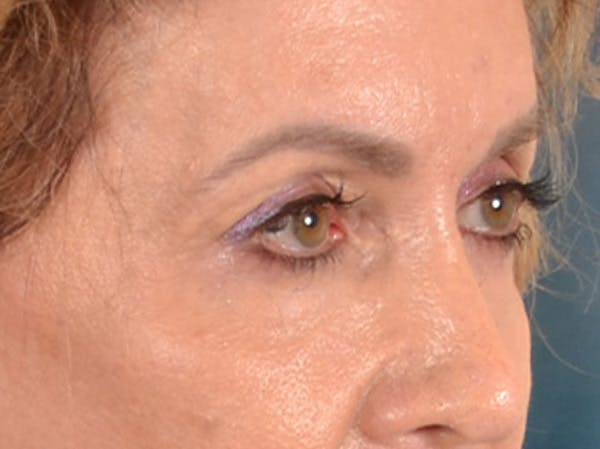 Eyelid Lift Before & After Gallery - Patient 138692 - Image 3