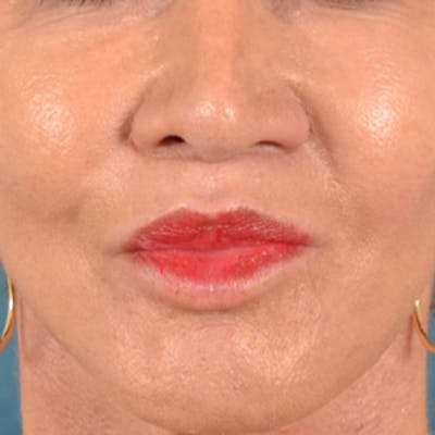 Lip Lift Before & After Gallery - Patient 113468 - Image 2