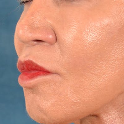 Lip Lift Before & After Gallery - Patient 113468 - Image 8