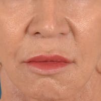 Lip Lift Before & After Gallery - Patient 113468 - Image 1