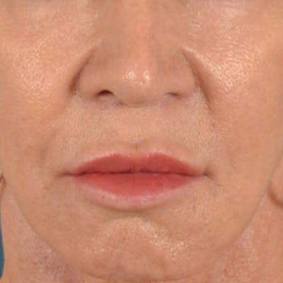 Lip Lift Before & After Gallery - Patient 113468 - Image 1