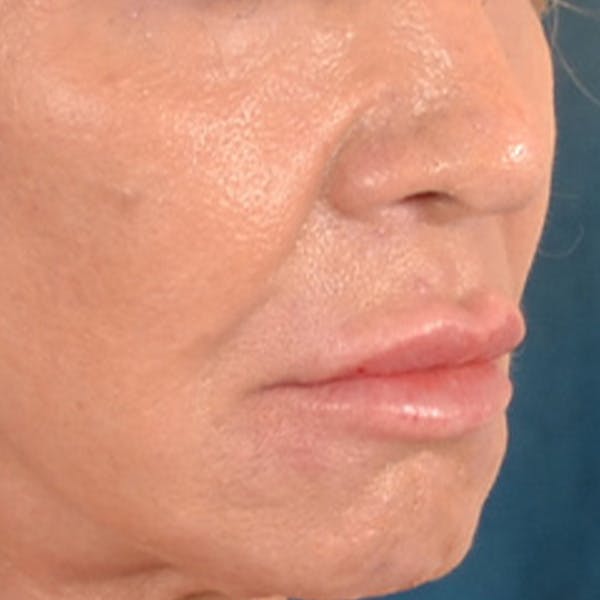 Lip Lift Before & After Gallery - Patient 113468 - Image 3