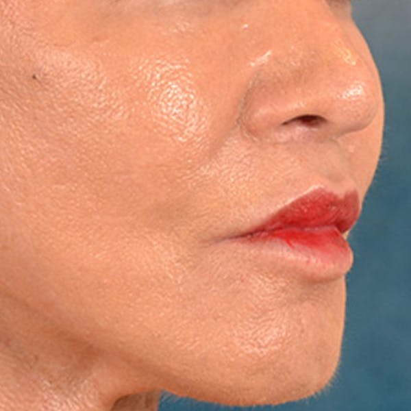 Lip Lift Before & After Gallery - Patient 113468 - Image 4