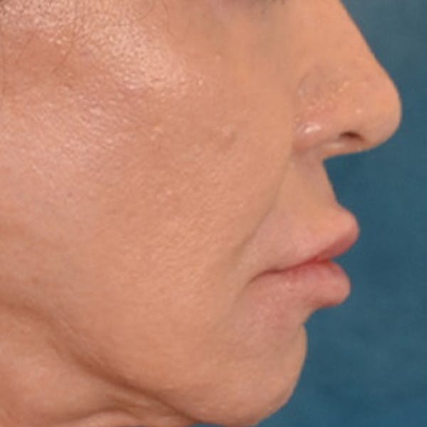 Lip Lift Before & After Gallery - Patient 113468 - Image 5