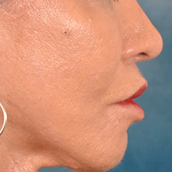 Lip Lift Before & After Gallery - Patient 113468 - Image 6