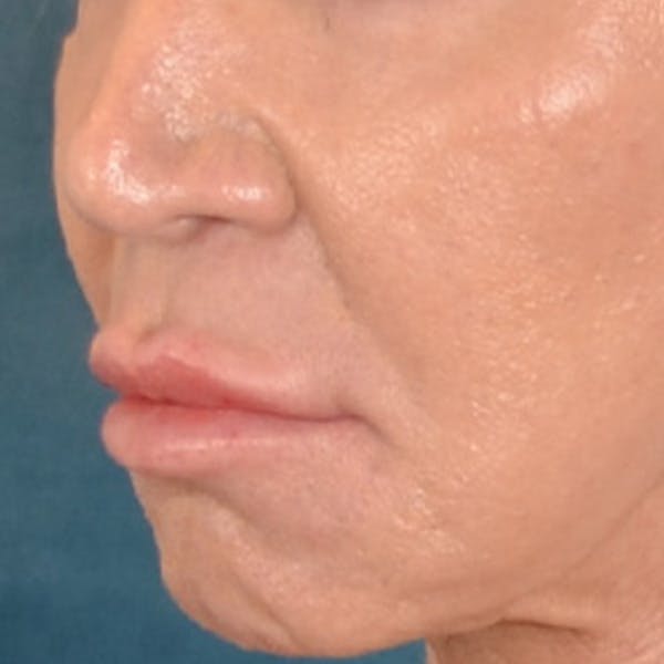 Lip Lift Before & After Gallery - Patient 113468 - Image 7