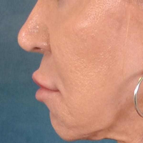 Lip Lift Before & After Gallery - Patient 113468 - Image 9