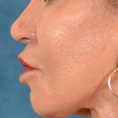 Lip Lift Before & After Gallery - Patient 113468 - Image 10