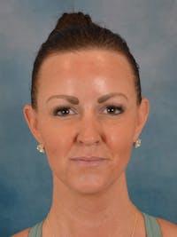Deep Neck Lift Before & After Gallery - Patient 113385 - Image 1