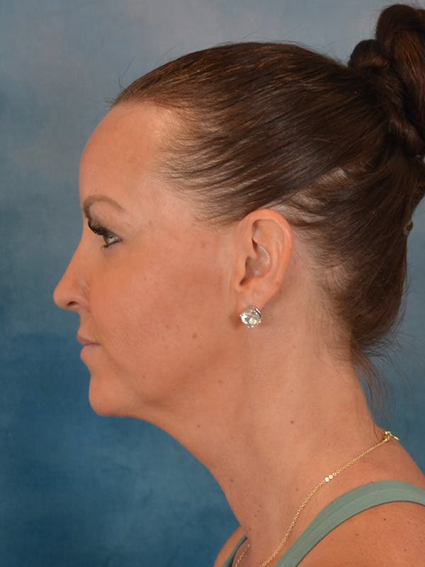 Deep Neck Lift Before & After Gallery - Patient 113385 - Image 9