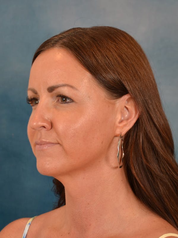 Deep Neck Lift Before & After Gallery - Patient 113385 - Image 8