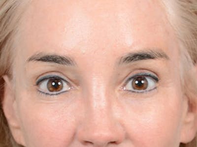 Eyelid Lift Before & After Gallery - Patient 86233193 - Image 2