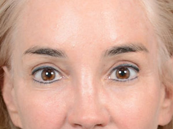 Eyelid Lift Before & After Gallery - Patient 86233193 - Image 2