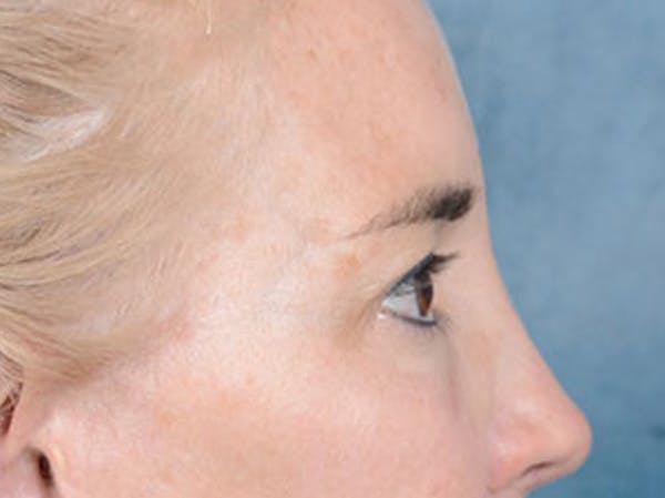 Eyelid Lift Before & After Gallery - Patient 86233193 - Image 5