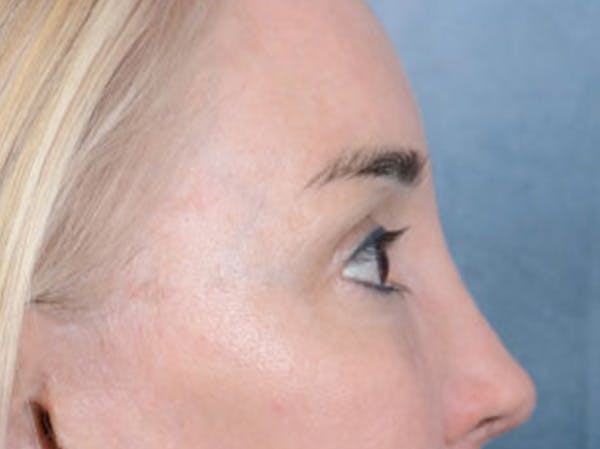 Eyelid Lift Before & After Gallery - Patient 86233193 - Image 6