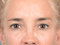 Eyelid Lift Before & After Gallery - Patient 86233193 - Image 1
