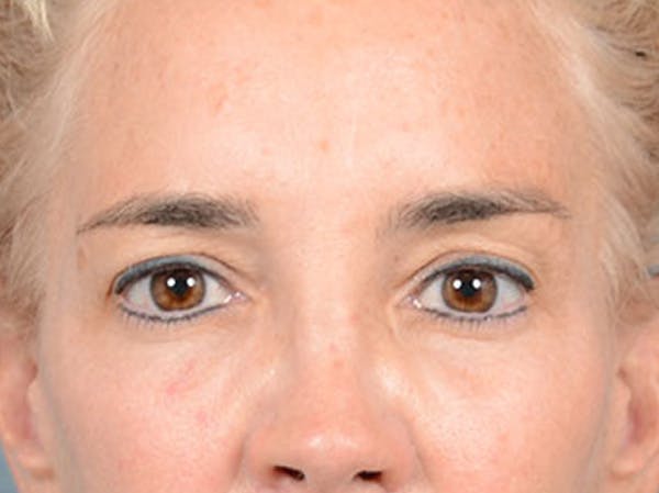 Eyelid Lift Before & After Gallery - Patient 86233193 - Image 1