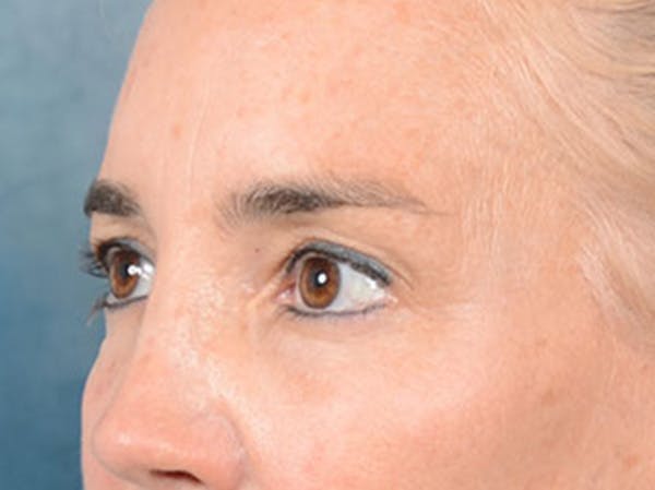 Eyelid Lift Before & After Gallery - Patient 86233193 - Image 7