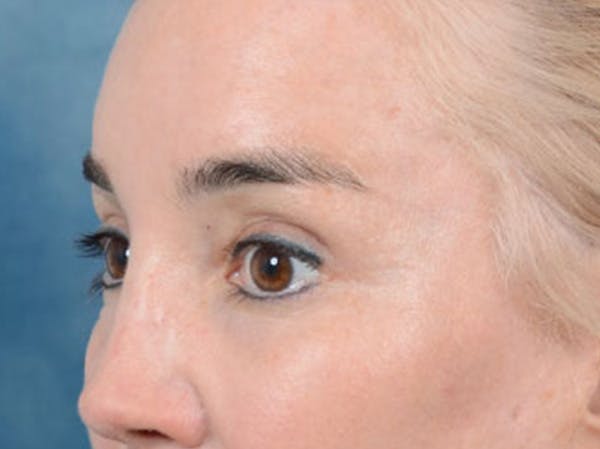 Eyelid Lift Before & After Gallery - Patient 86233193 - Image 8