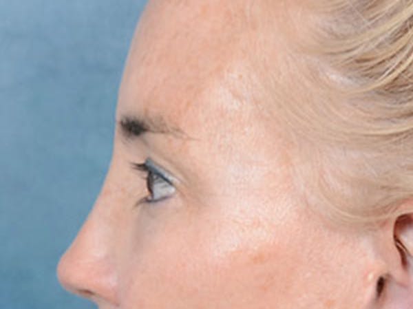 Eyelid Lift Before & After Gallery - Patient 86233193 - Image 9