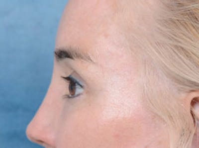 Eyelid Lift Before & After Gallery - Patient 86233193 - Image 10