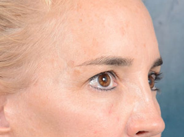 Eyelid Lift Before & After Gallery - Patient 86233193 - Image 3