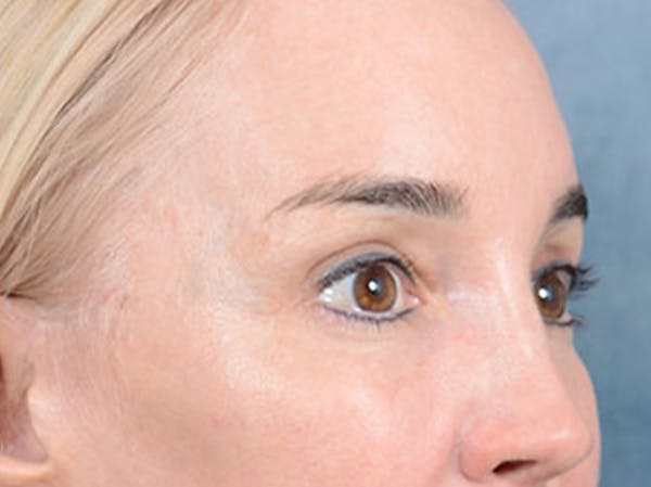 Eyelid Lift Before & After Gallery - Patient 86233193 - Image 4