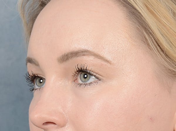 Eyelid Lift Before & After Gallery - Patient 121118824 - Image 3