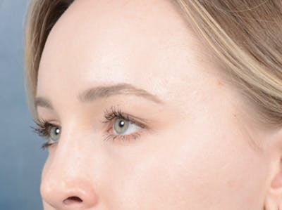 Eyelid Lift Before & After Gallery - Patient 121118824 - Image 4