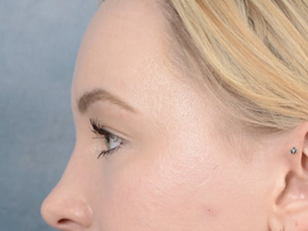 Eyelid Lift Before & After Gallery - Patient 121118824 - Image 5
